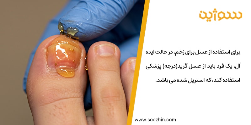 عسل برای درمان عفونت پا